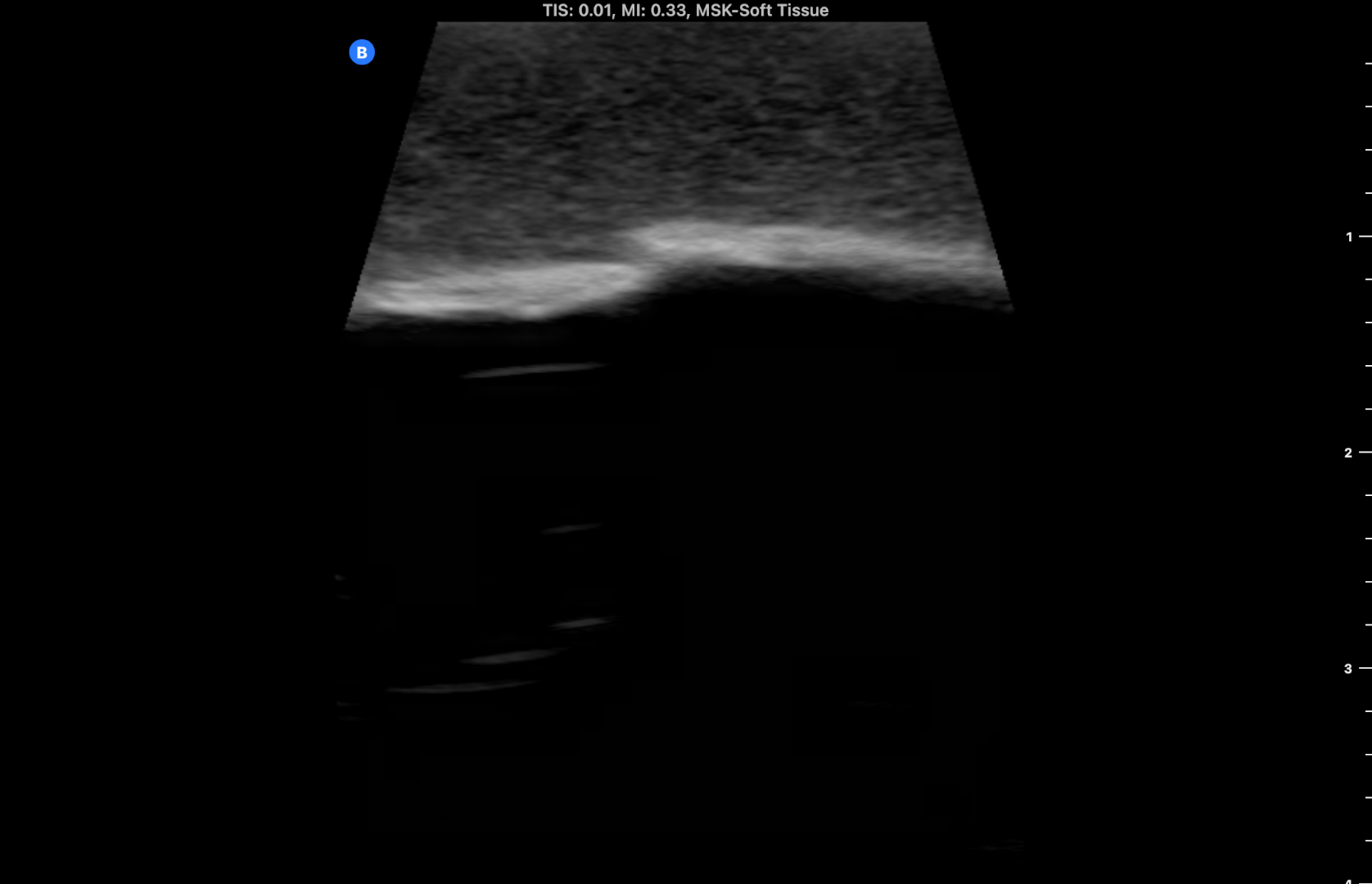 Ultrasound Phantom - Bone Fracture, Light | Adam,Rouilly