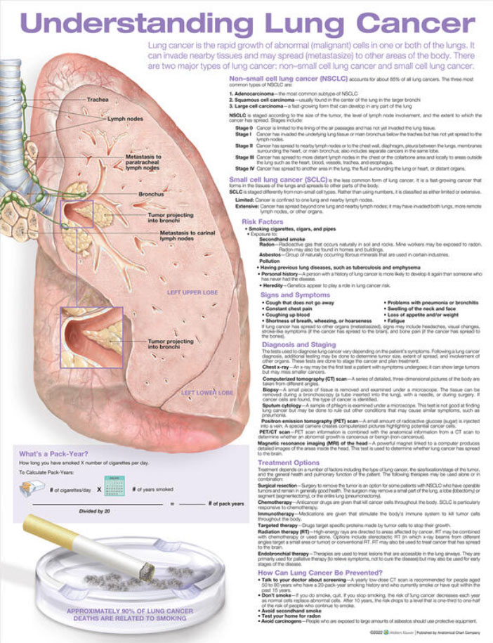 Understanding Lung Cancer Chart | Adam,Rouilly