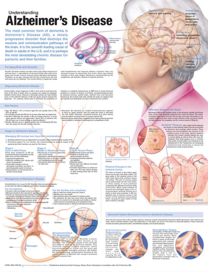 Understanding Alzheimer's Chart - Adam,Rouilly