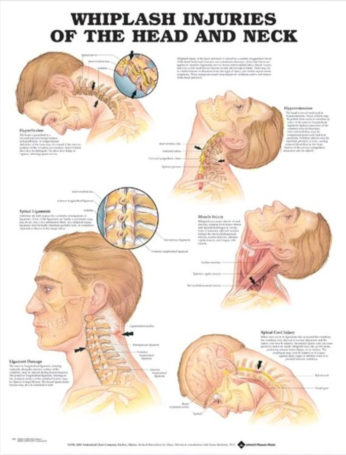 Whiplash Injuries Of The Head & Neck Chart | Adam,Rouilly