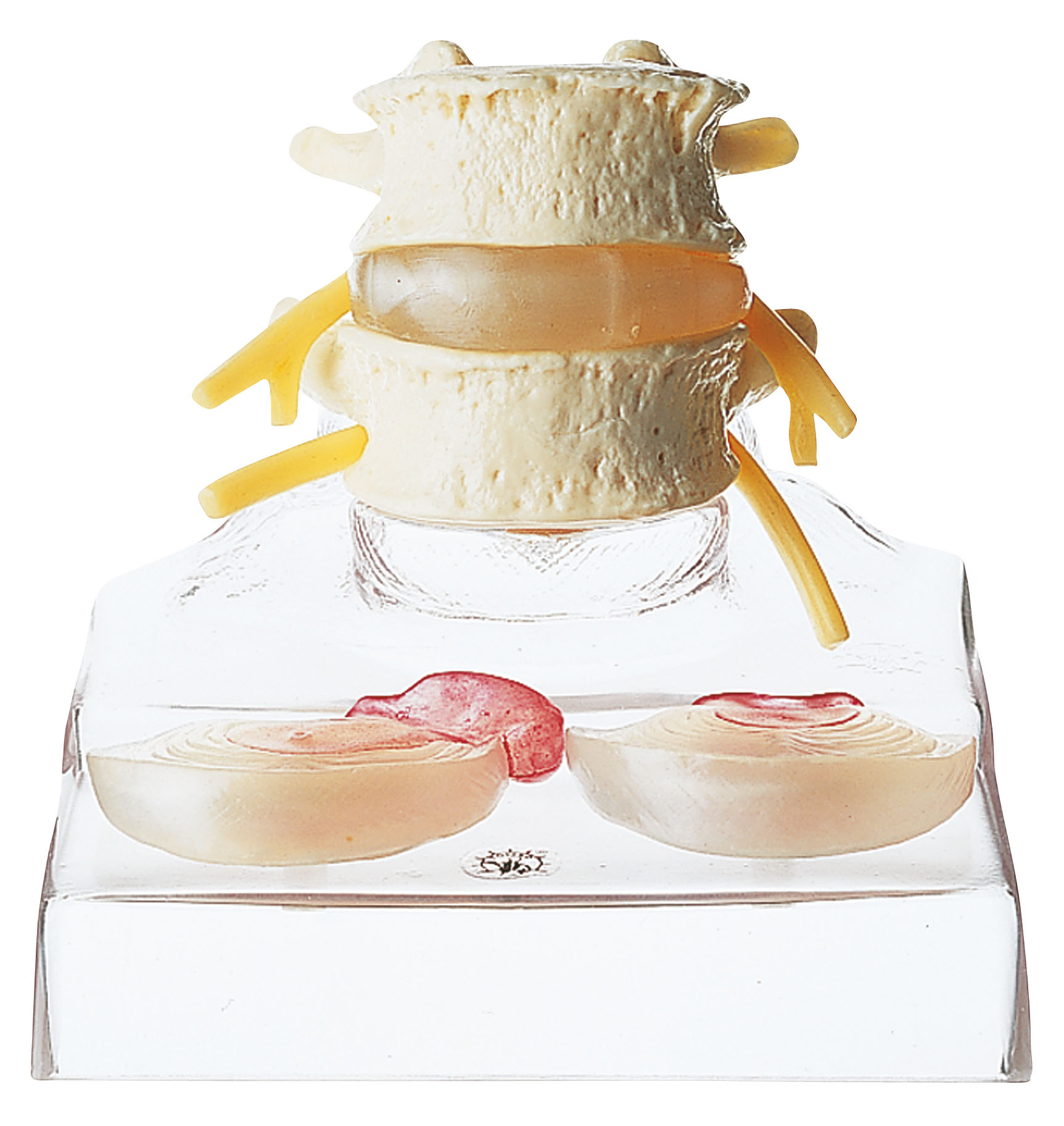 Central & Dorsolateral Herniated Disc | Adam,Rouilly